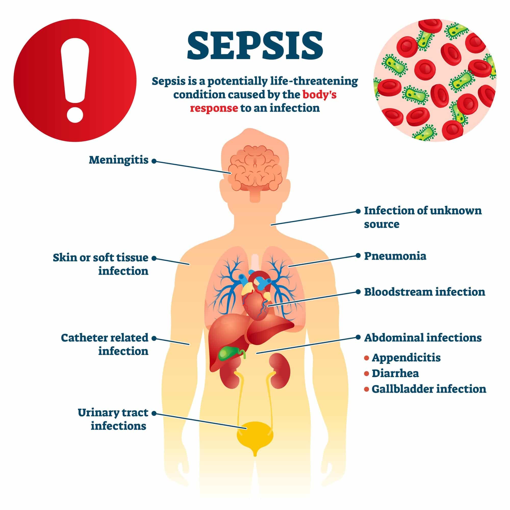 Welt-Sepsis-Tag 1 AdobeStock 339383900 1